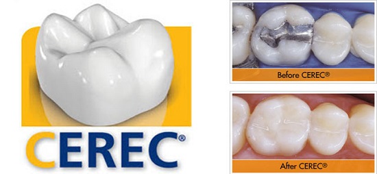 CEREC crowns have you in-and-out of the office in one session Brookfield dental bridge