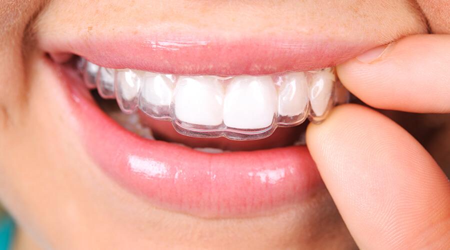 Ask about custom clear aligners - an affordable Invisalign® alternative Ross Dental patient straightening her teeth with clear aligner treatment