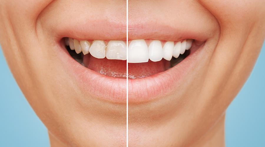 Before & after cosmetic dentistry from Ross Dental