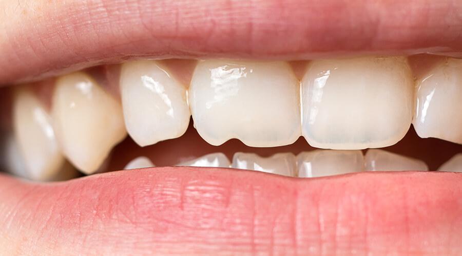 Fill in cracks & gaps with affordable composite resin Patient with a chipped tooth - ideal candidate for dental bonding