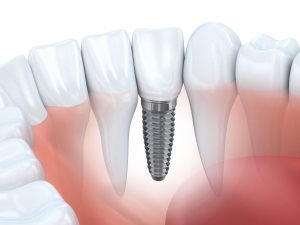 dental implant procedure aftercare guide