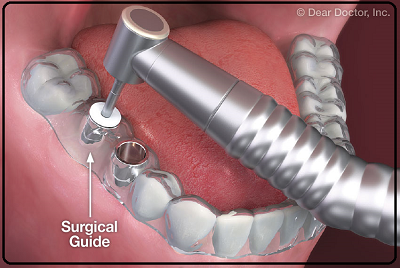 Surgical Guide for Dental Implant Procedure