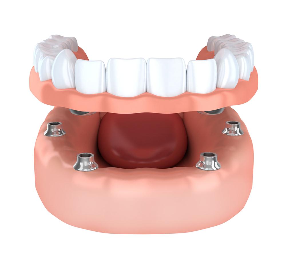 Get a consultation at Ross Dental in New Berlin All on four implant supported dentures