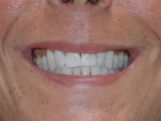 After cosmetic dental work