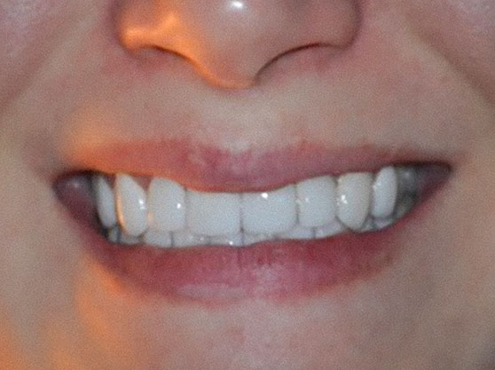 After composite veneers