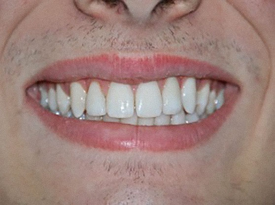 After clear aligners