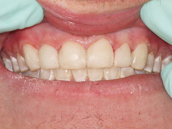 After composite veneers