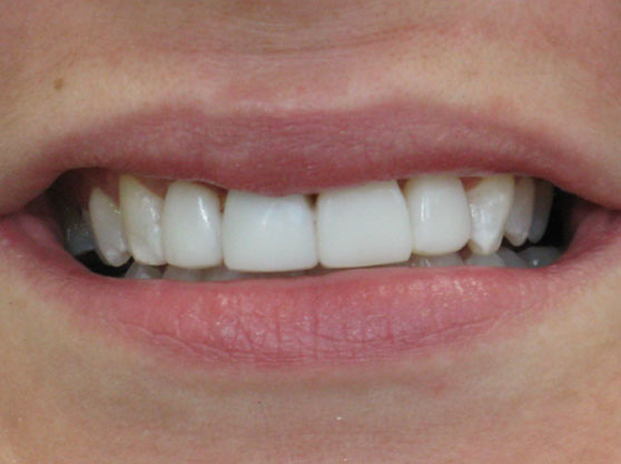 After bonded veneers