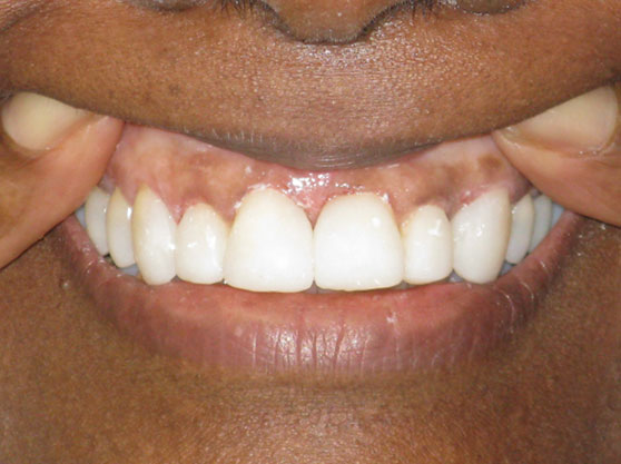 After porcelain veneers