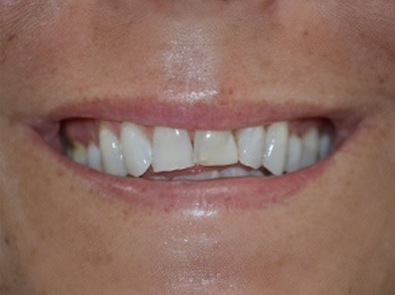 Before cosmetic dental work