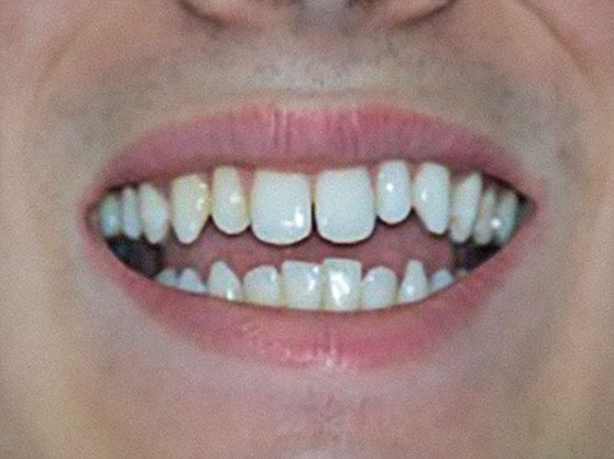 Before clear aligners