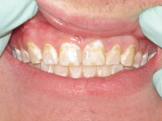 Before composite veneers