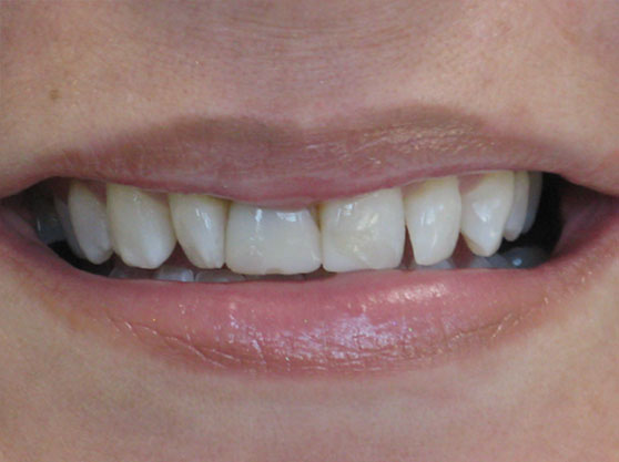 Before bonded veneers