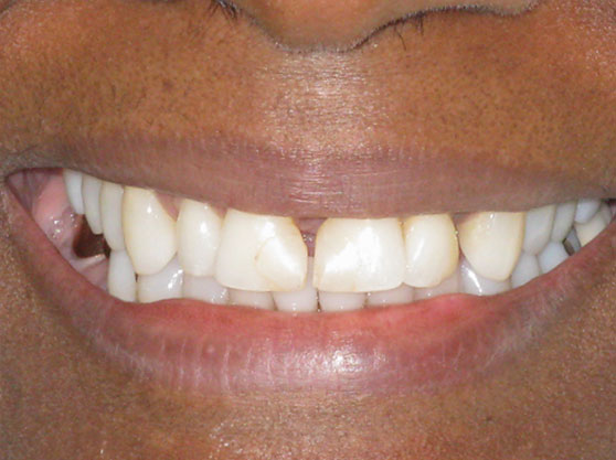 Before porcelain veneers