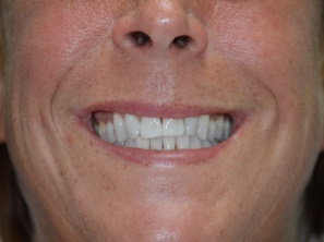 Before & After Dental Work