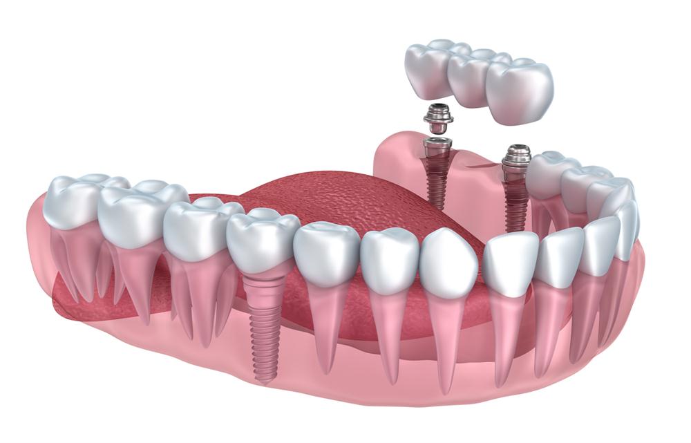 Multiple tooth implants: replace missing teeth in Waukesha