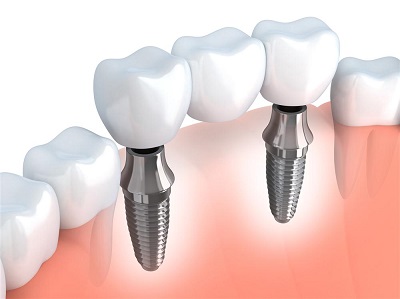 Dental implant specialist: Waukesha, Milwaukee, WI