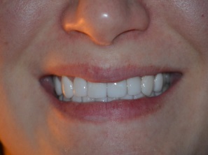 Before & After Cosmetic Dentistry