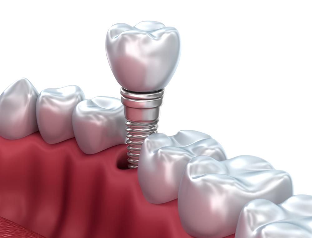 Dental implant installation proces Single tooth replacment: Costs of dental implant vs bridge
