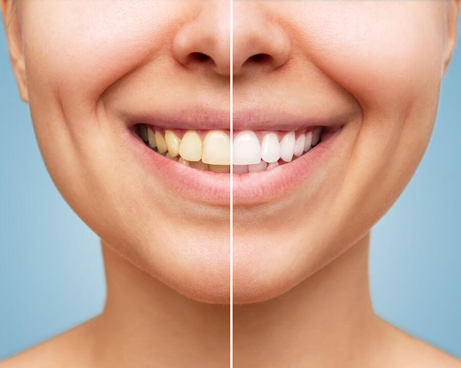 Brighten your smile in as little as one visit! Ross Dental patient before & after teeth whitening