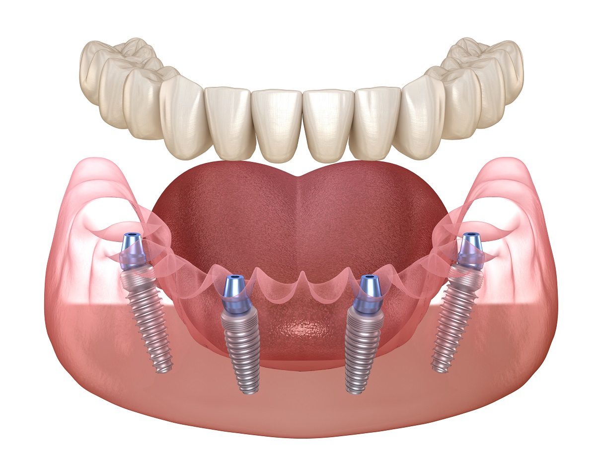 All-on-4 dental implants in New Berlin & Waukesha