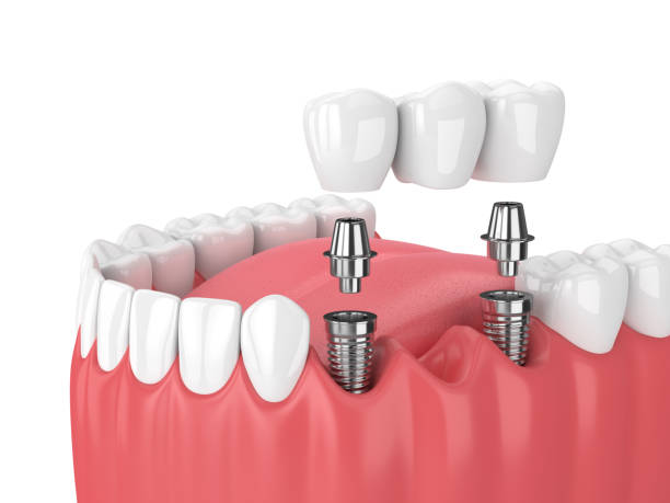 Single tooth replacment: Costs of dental bridge